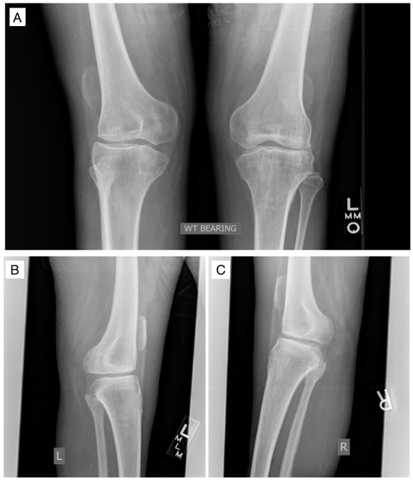 Bilateral AP (A) radiograph of the knees with left lateral (B) and right lateral (C) knee radiographs demonstrating severe degenerative changes and arthrosis from spina bifida.