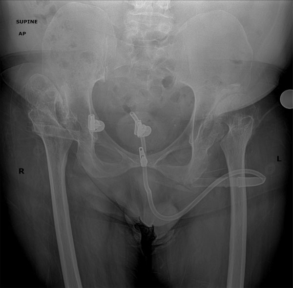 AP radiograph of the pelvis demonstrating severe dysplastic changes of the hips of a 44-year-old patient with spina bifida, which often arises in the setting of severe lumbosacral lesions.