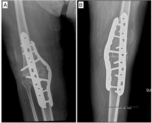 Bilateral AP radiographs of the right (A) and left (B) knees demonstrating arthrodesis hardware in appropriate positions with appropriately healed surgical incisions.