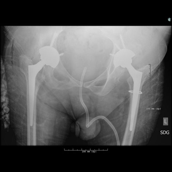 AP radiograph of the pelvis demonstrating uncemented bilateral total hip arthroplasty with a single Dall-Miles cable transfixing a fracture of the left medial proximal femur.