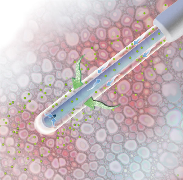 Chemical substances from the extracellular fluid diffuse through the dialysis membrane and are carried out of the catheter by a flow of perfusion fluid to a microvial.