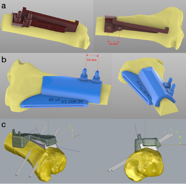 Patient-specific TTO guide model for a 60º anteromedialization TTO with 10 mm of translation: a) 60º osteotomy angle guide, b) 50-yard line horizontal cut guide, c) 10 mm translation guide