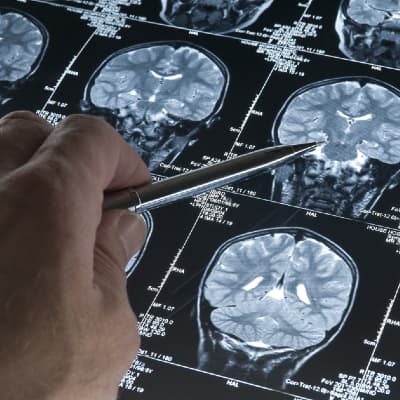 A doctor examining brain scans