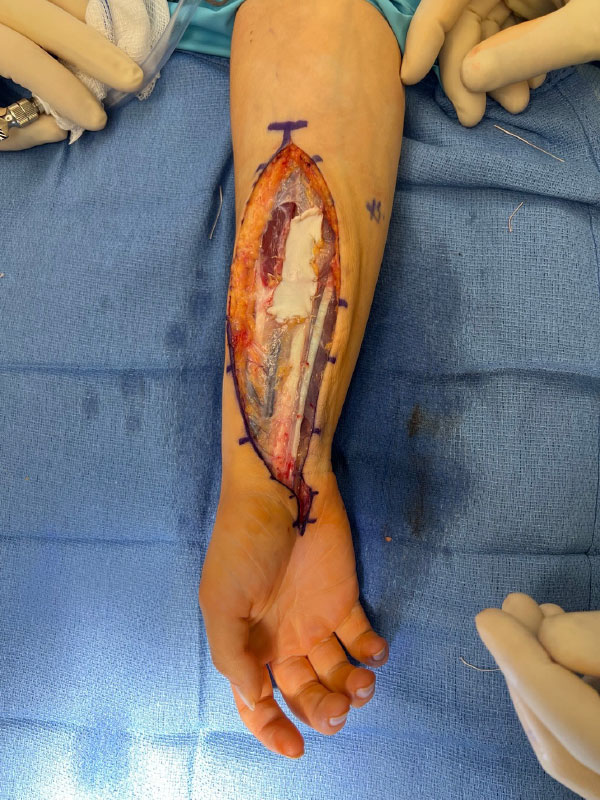 Repair of the fascial defect with acellular dermal allograft utilizing inlay technique