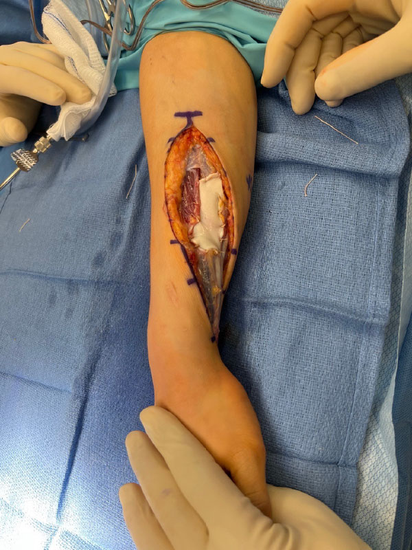 Resolution of muscle herniation in pronation following fascial reconstruction 