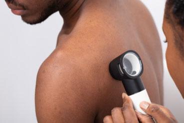 Skin Cancer Facts for Dark Skin - Feature
