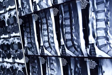 X-rays of lumbar spines