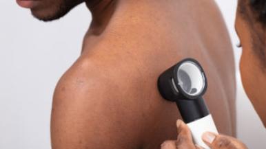 Skin Cancer Facts for Dark Skin - Feature