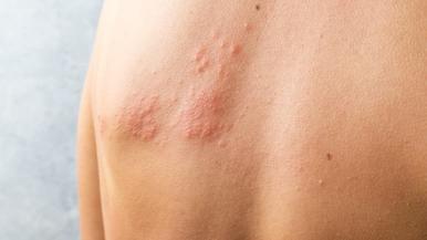 How Do You Get Rid of an Allergic Reaction Rash? - Oak Brook Allergists