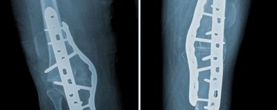 Bilateral Knee Arthrodesis and Total Hip Arthroplasty for Knee and Hip Dysplasia Secondary to Spina Bifida