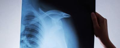 Repeat Shoulder Dislocations Associated With Revision Labral Repair